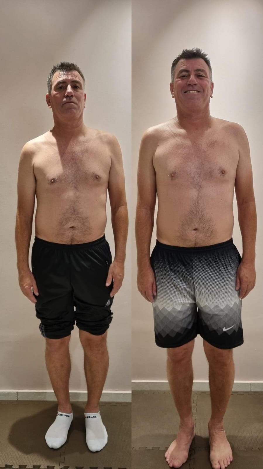 Paciente J.C. - comparativo frontal antes e depois do tratamento na Benevento Fisioterapia