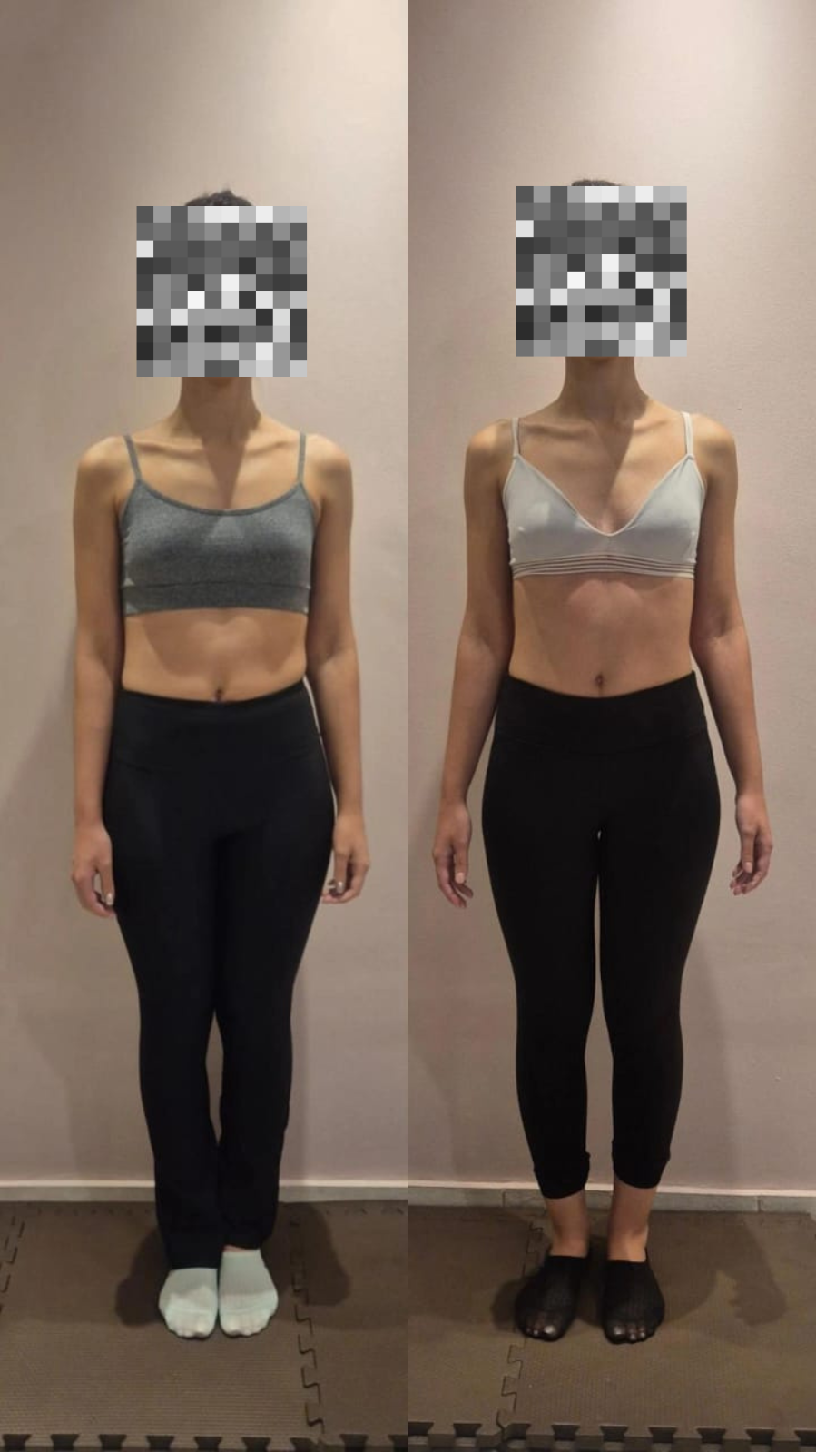 Paciente A.M. - comparativo frontal antes e depois do tratamento na Benevento Fisioterapia